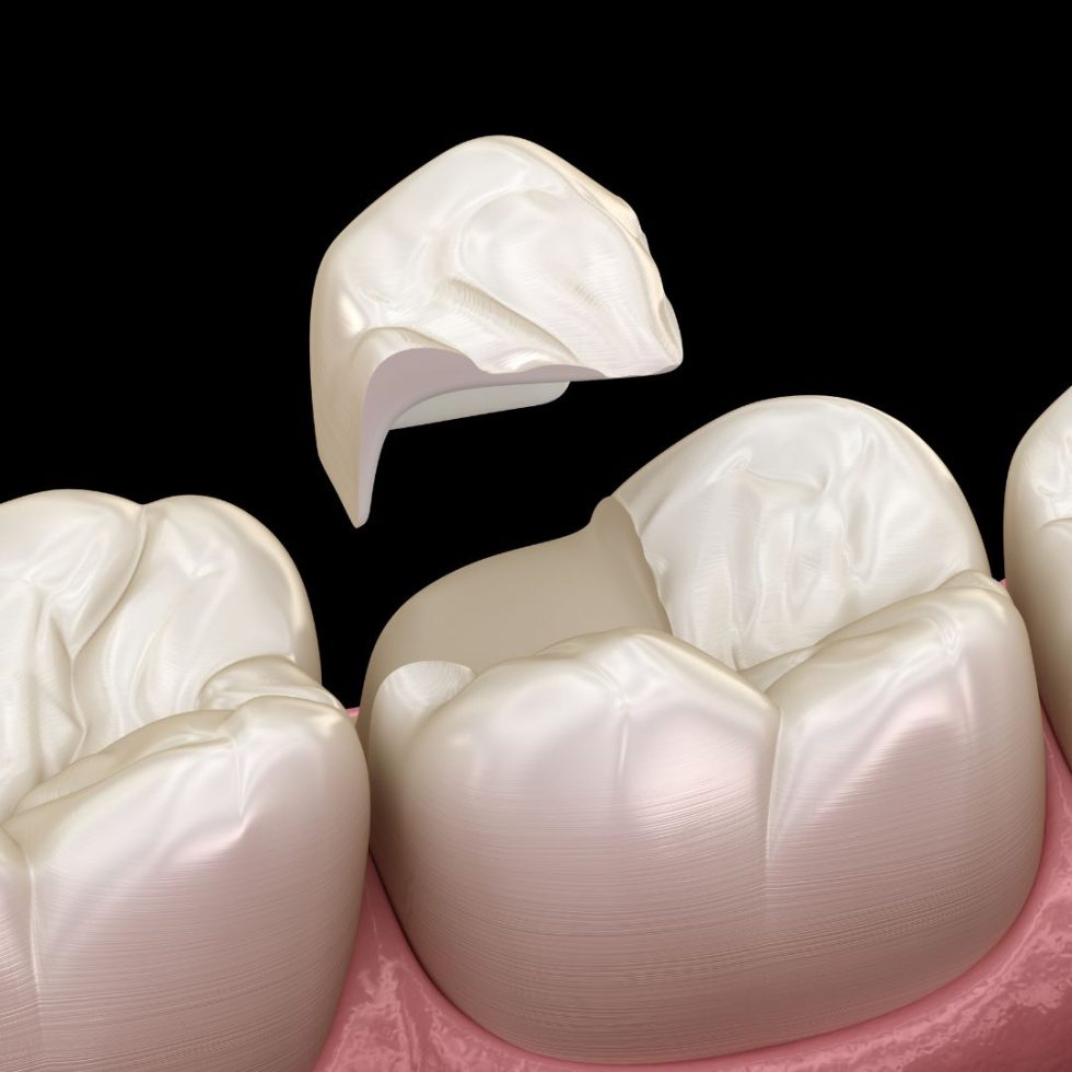 Is Dental Bonding a Permanent Solution? What to Expect and How to Maintain It