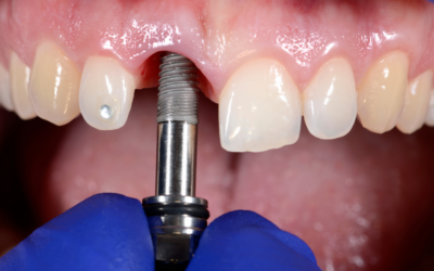 The Hidden Problems of a Missing Tooth and How a Single Implant Can Help