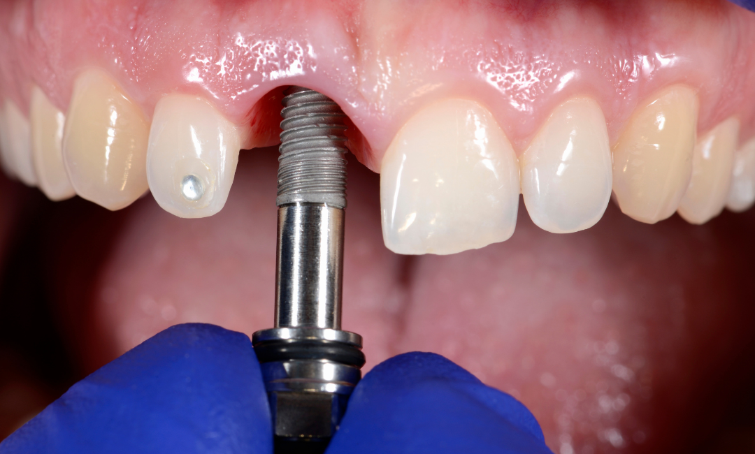 Single Dental Implant Penrith